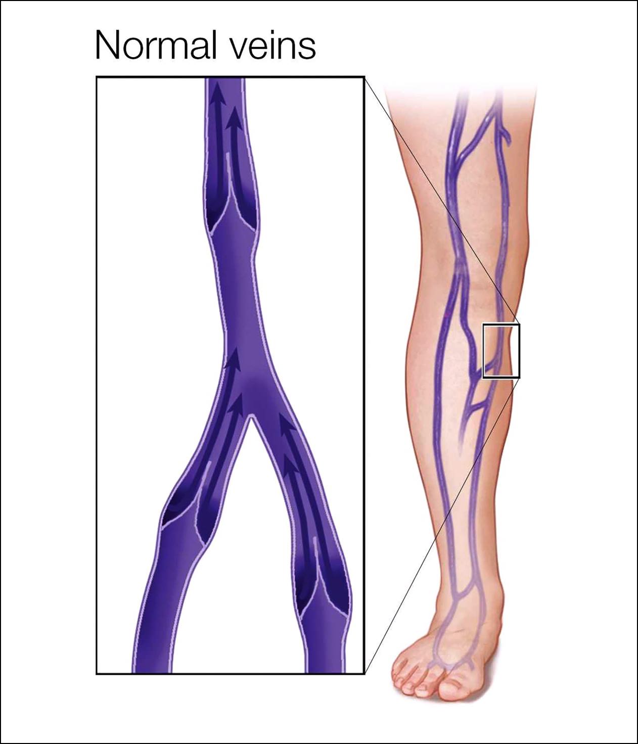 Venous Disease/Chronic Venous Insufficiency SFVVG